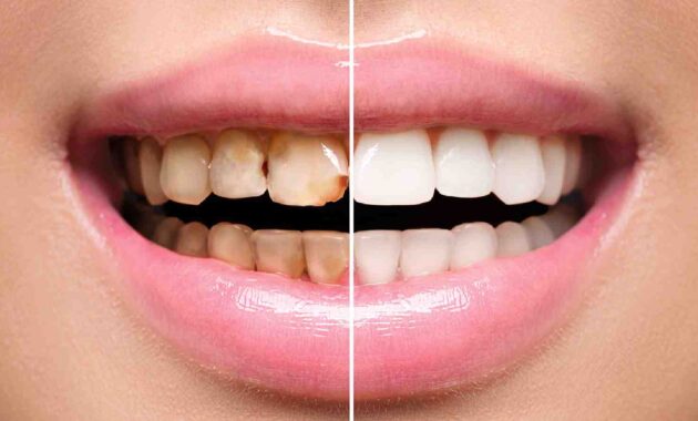 5 simple ways to get rid of tartar from teeth at home