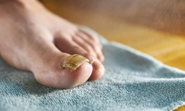 Toenail fungus home remedy: White vinegar vs apple cider vinegar