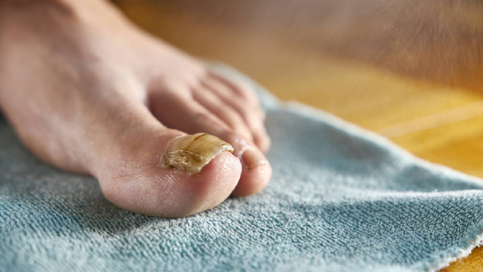 Toenail fungus home remedy: White vinegar vs apple cider vinegar