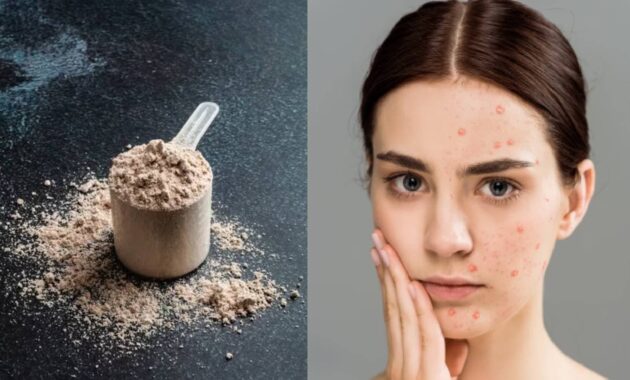 Whey protein side effects on skin: Can it cause acne?