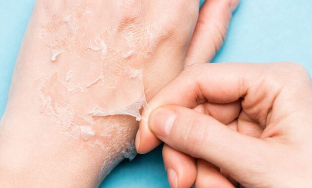 Dry peeling skin: 7 home remedies you can try