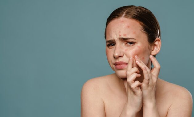 Winter acne breakouts: Causes and 11 tips to deal with it