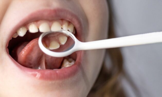 Know the early signs of tooth decay in children