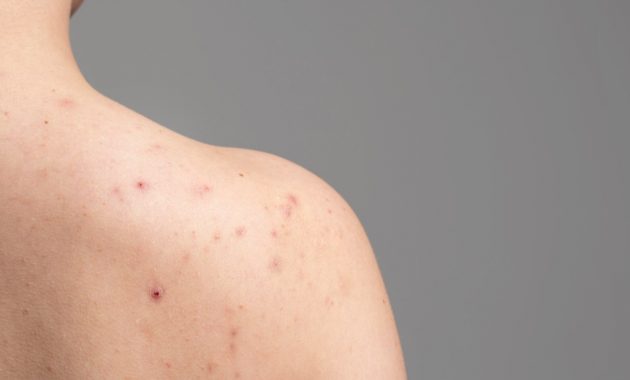 Shoulder acne: Causes and home remedies