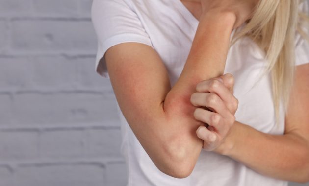 5 home remedies for eczema you must try!