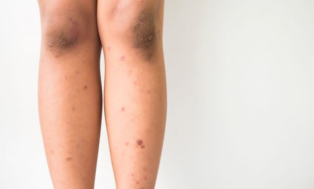 Dark spots on legs: Why does this happen and how to treat them